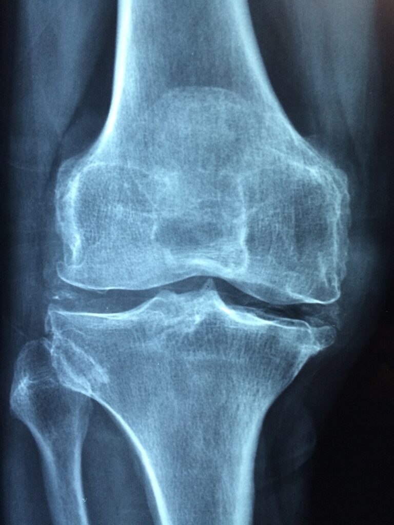 knee, old, care-1406964.jpg